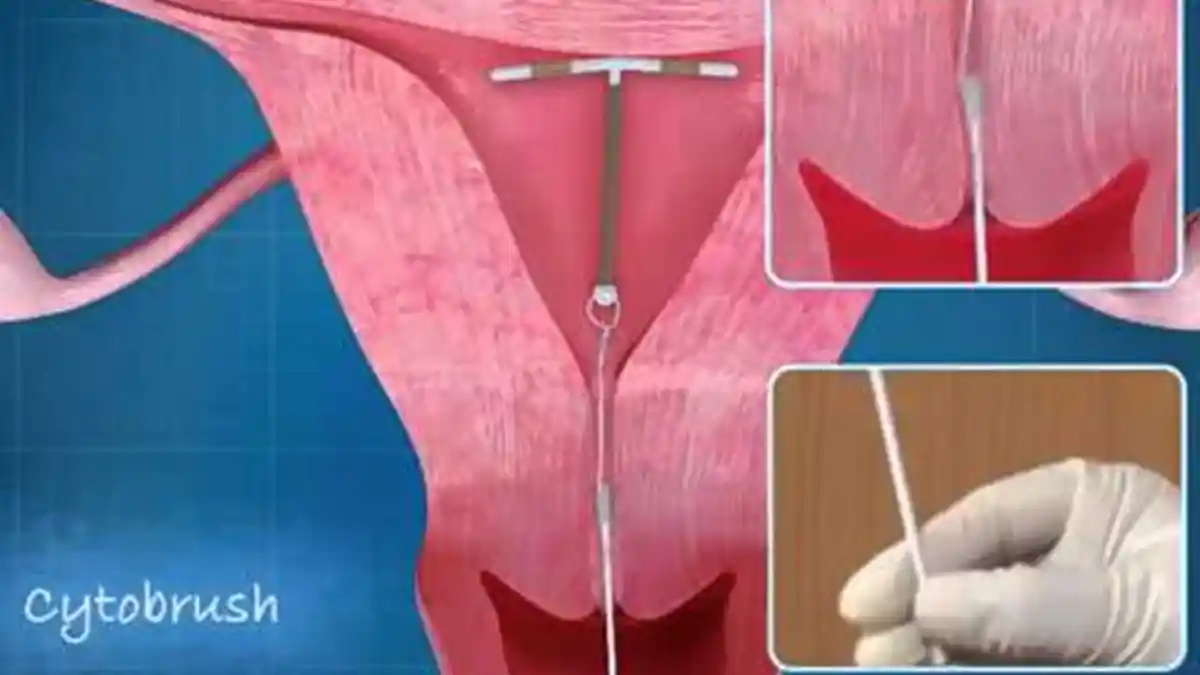 Bingung Pilih Alat KB Karena Takut Gemuk, Wanita Baca Ini!