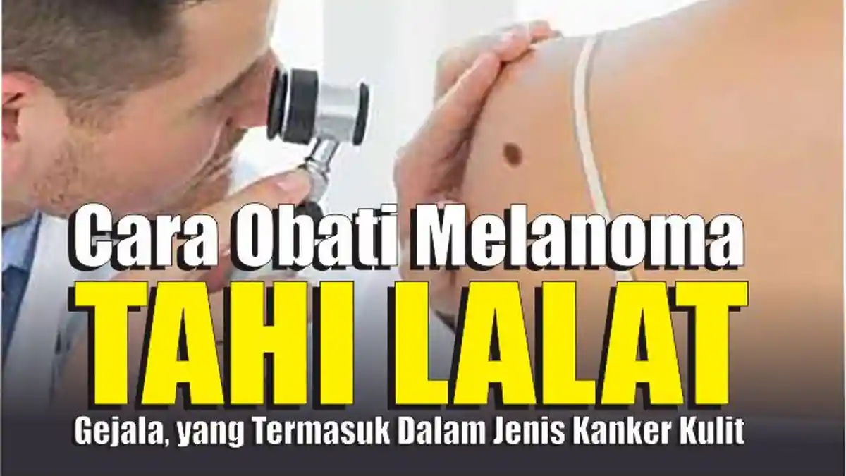 Kenali Gejala dan Pengobatan Melanoma, Tahi Lalat  yang Termasuk Dalam Jenis Kanker Kulit
