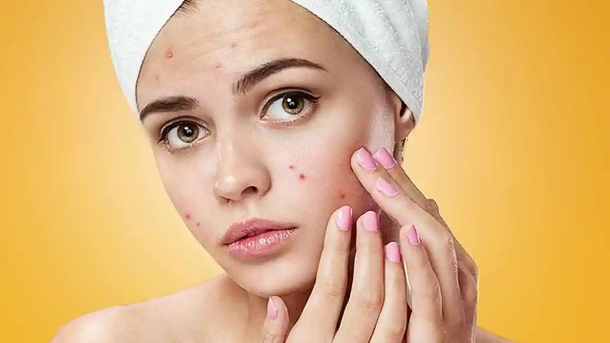 Tips Hilangkan Jerawat dengan 4 Bahan Alami Ini, Aman dan Mudah Dicari, Begini Cara Menggunakannya