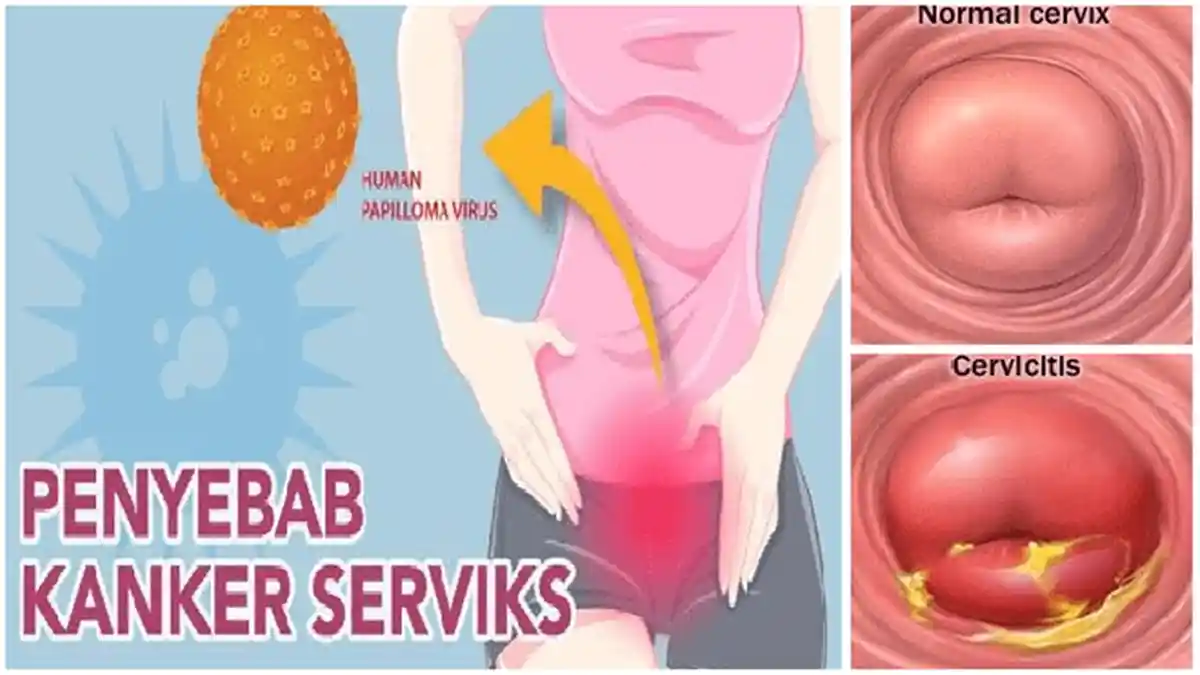 Wanita Harus Berhati-hati Nih, Kanker Serviks Stadium Awal Gak Ada Gejala Apapun, Perhatikan Hal Ini