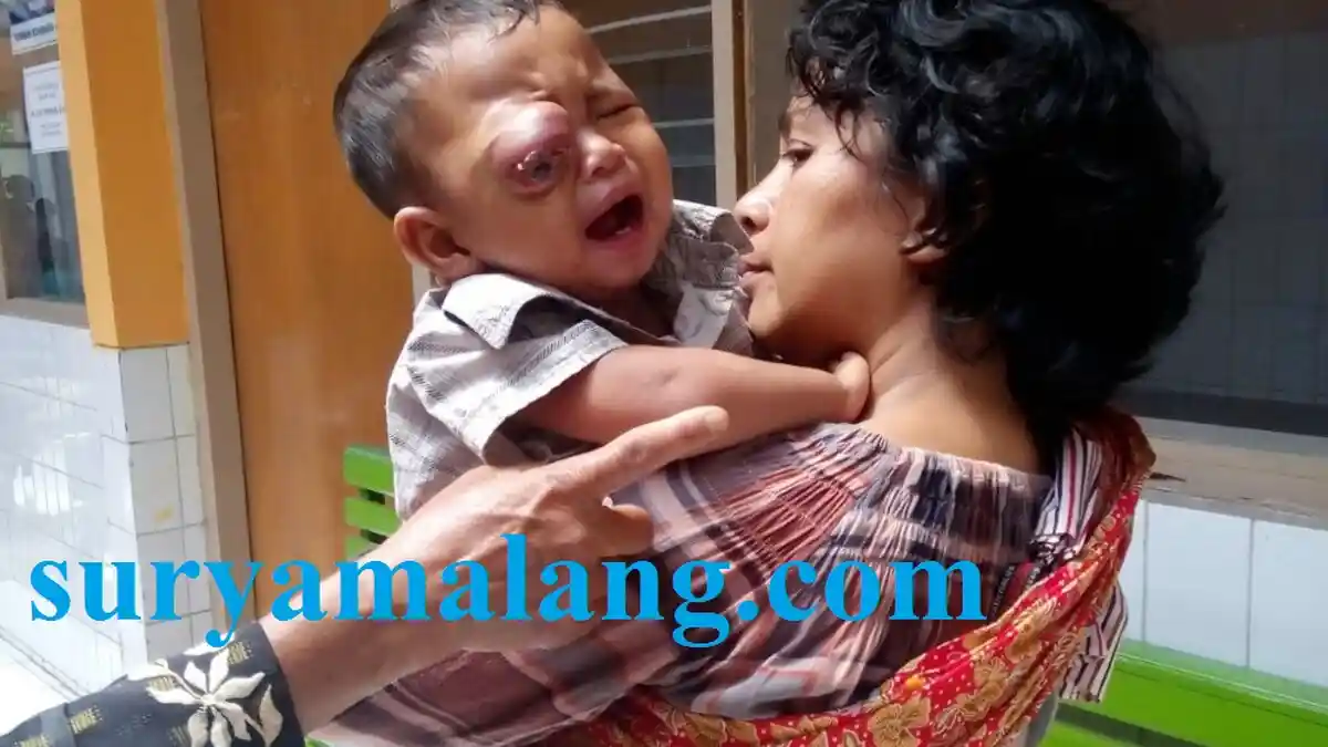 Mata Bocah Ini Nyaris Meletus, ‘Diusir’ RSUD Karena Tak Punya Rp 70 Juta