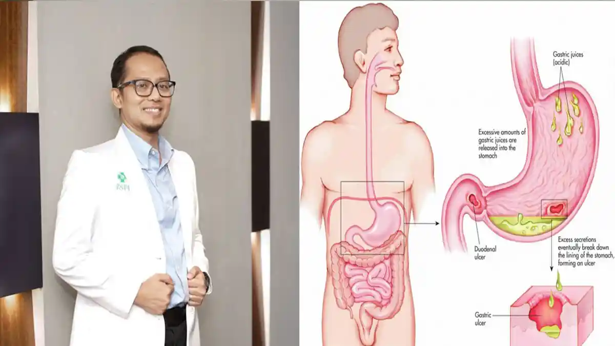 TANDA Gerd Sudah Sembuh yang Bisa Dirasakan Penderita Setelah Masa Pengobatan dan Pola Gaya Hidup