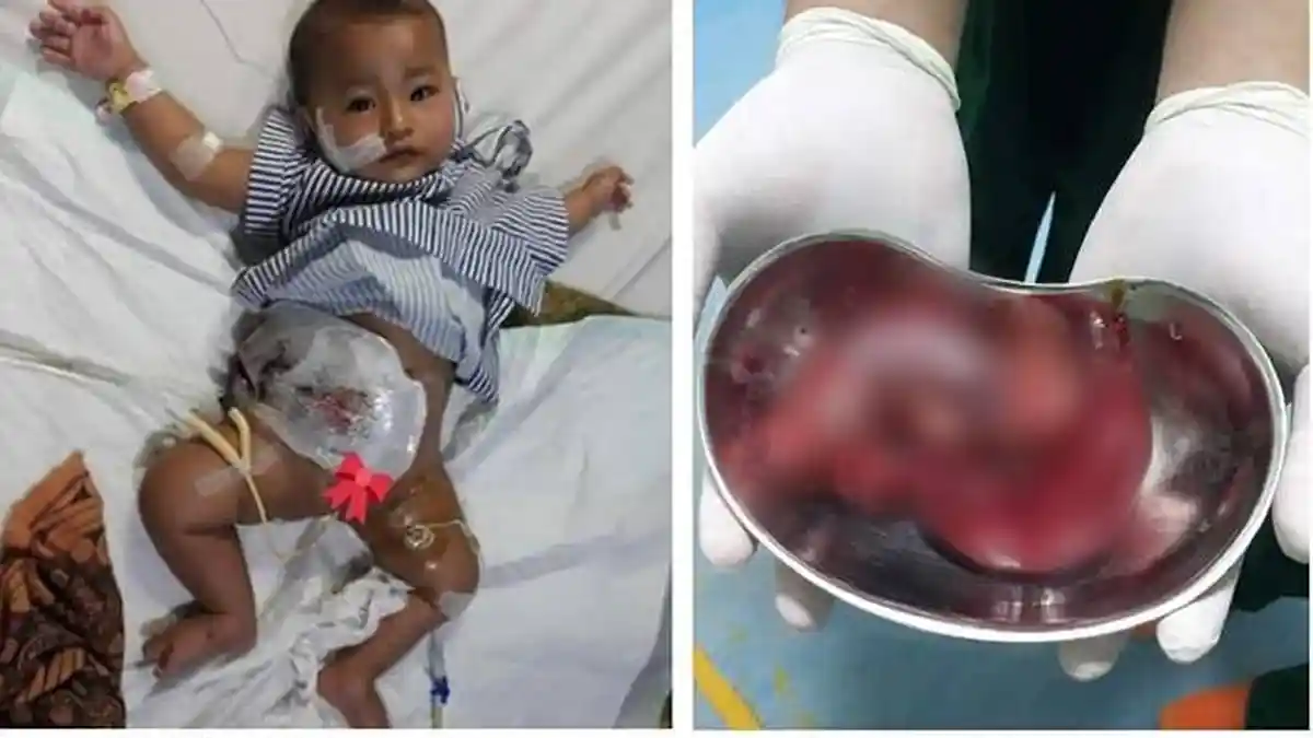 Viral, Gara-gara Diberi Makan, Perut Bayi Usia 5 Bulan Ini Alami Hal yang Tak Terduga