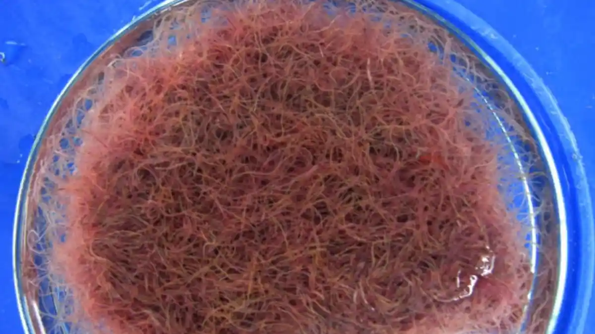 Balita Gizi Buruk Meninggal, Tubuh Dipenuhi Cacing hingga Sekilo