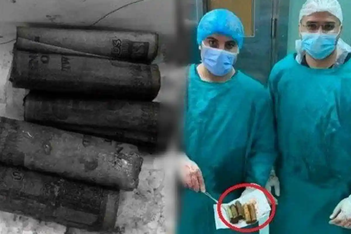 Tak Habis Pikir, Pertama Terjadi, Dokter Kaget Temukan Uang Rp 5,6 Juta saat Perut Pasien Dibedah