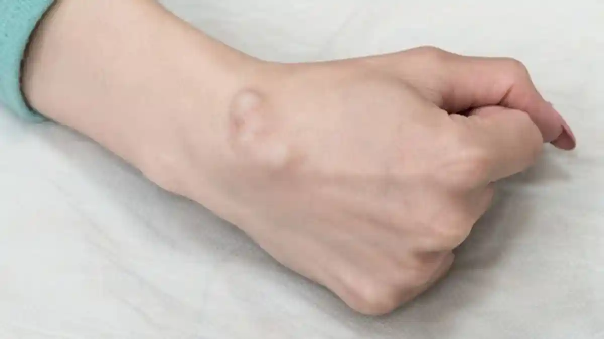 BENJOLAN pada Tangan Seperti Ini Bisa Jadi Kista Ganglion, Benarkah?