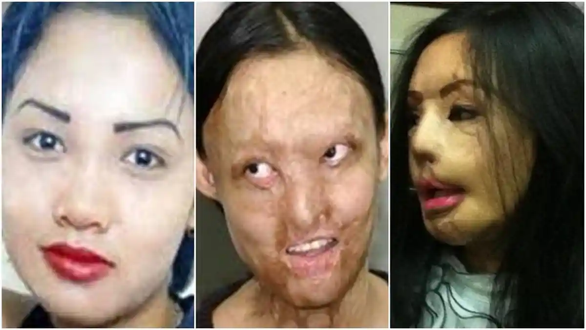 Sejarah Hari Ini: Operasi Face Off Pertama di Indonesia atas Pasien Lisa, Begini Kondisinya Sekarang