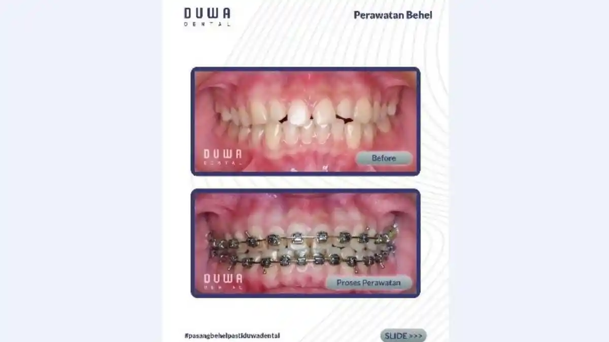 Duwa Dental Hadirkan Perawatan Ortodonti Sebagai Layanan Unggulan