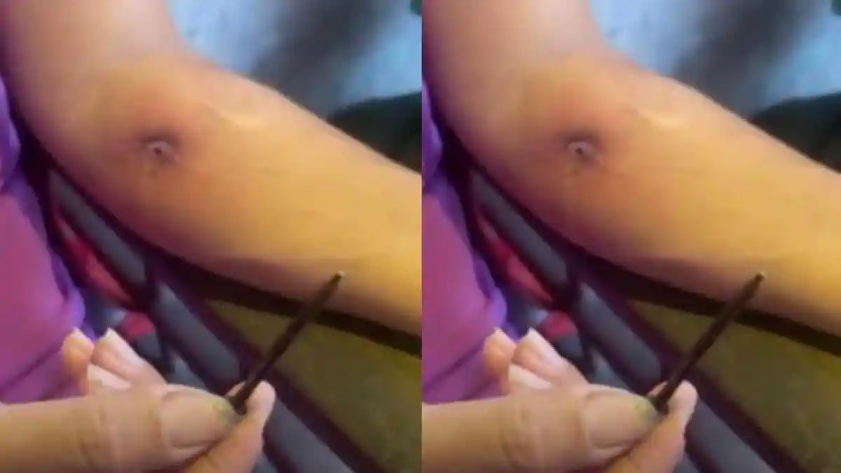 Seorang Wanita Diduga Korban Santet, Lusinan Paku Keluar dari Luka di Lengan, Ini Fakta Sebenarnya