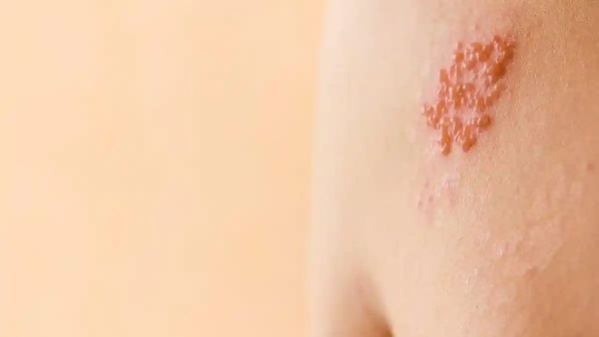 Mengenal Penyakit Herpes Zoster atau Cacar Api, Apa saja Penyebab dan Gejalanya?