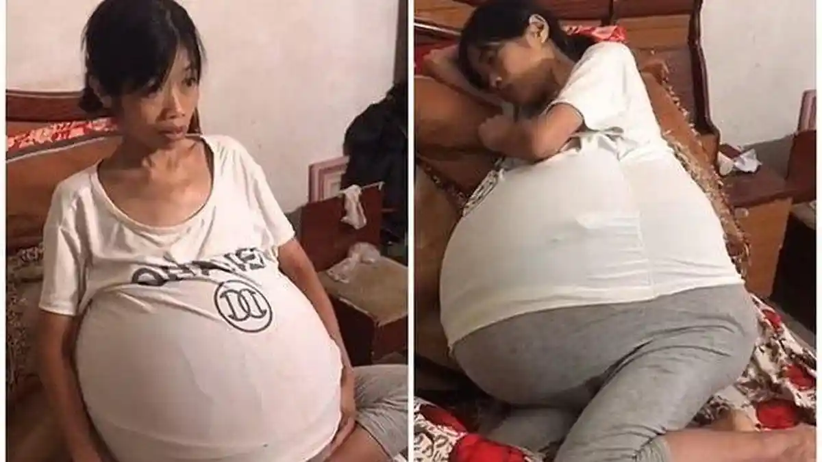 Membesar bak Hamil Anak Kembar, Anehnya Perut Buncitnya Sudah 2 Tahun, Dokter Bikin Wanita Ini Sedih