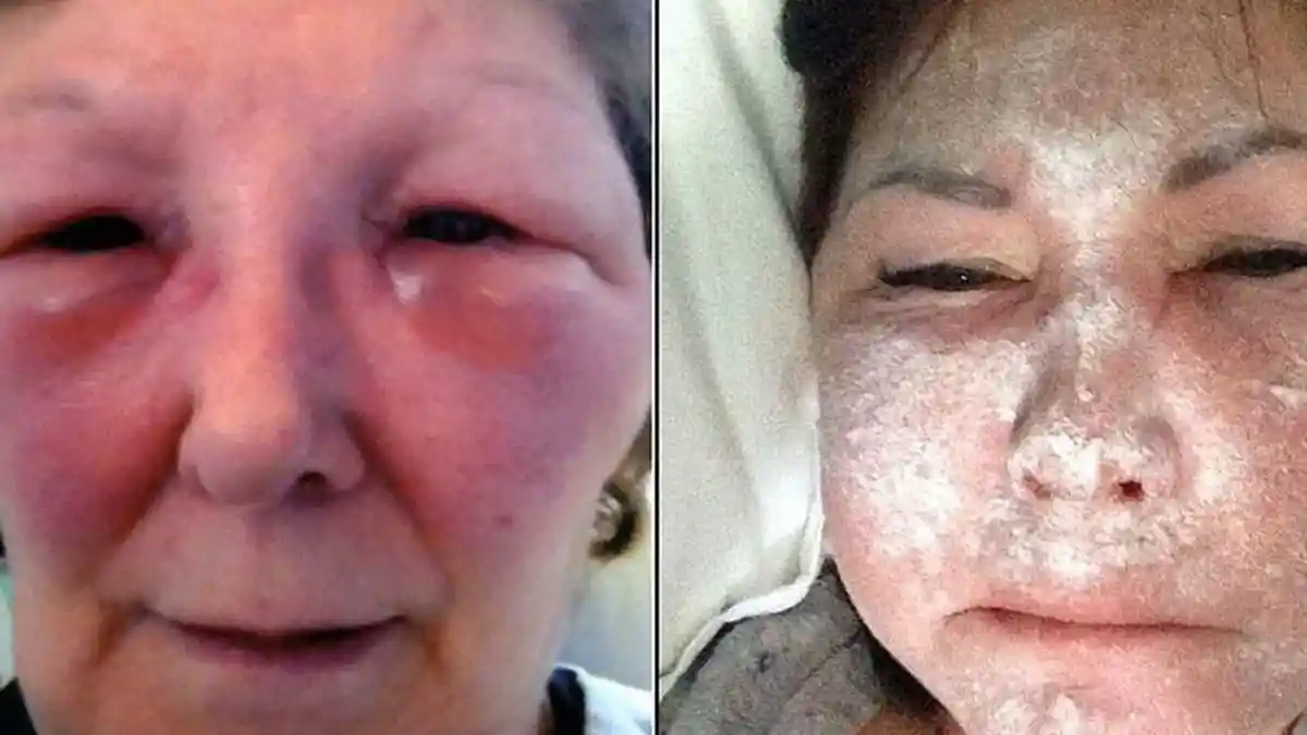 Lakukan Perawan Suntik Botoks, Wajah Wanita Ini Membeku, Rupanya Dibantu Dokter Gadungan   