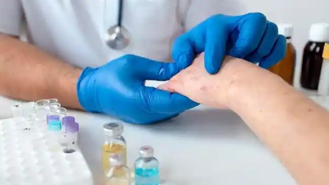 Mengenal Lupus, Penyakit Autoimun Pemilik Gejala Beragam Sulit Dikenali, Demam hingga Rambut Rontok