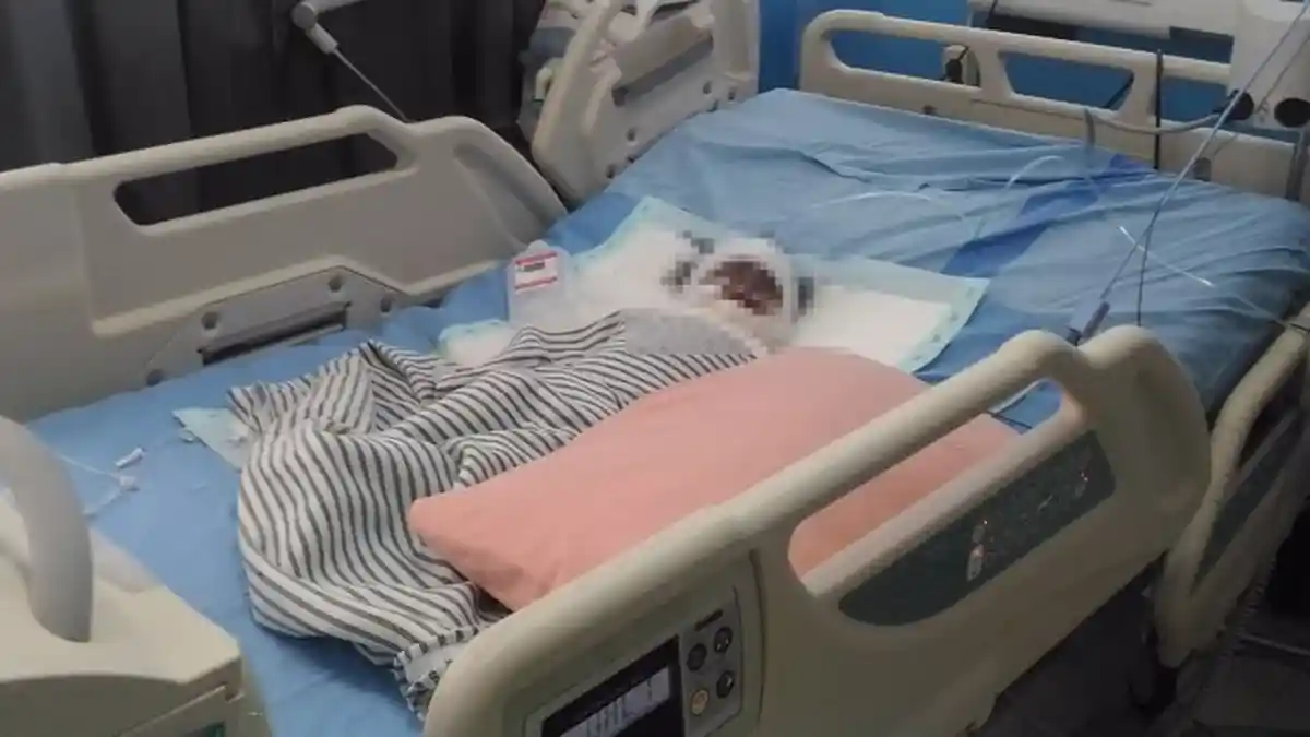 Balita Tercebur di Kuali Berisi Rebusan Air Gula