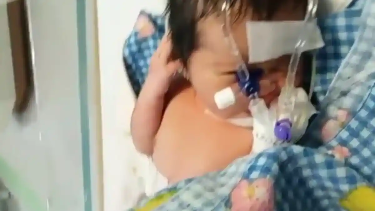 Lahir dengan Usus di Luar Perut, Bayi Perempuan Asal Kabupaten Sergai Butuh Uluran Tangan