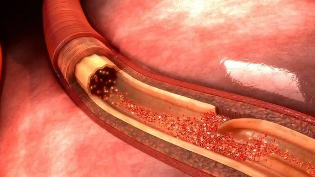 Apa Itu Diseksi Aorta? Ini Gejala, Penyebab, Faktor Risiko, dan Pencegahannya