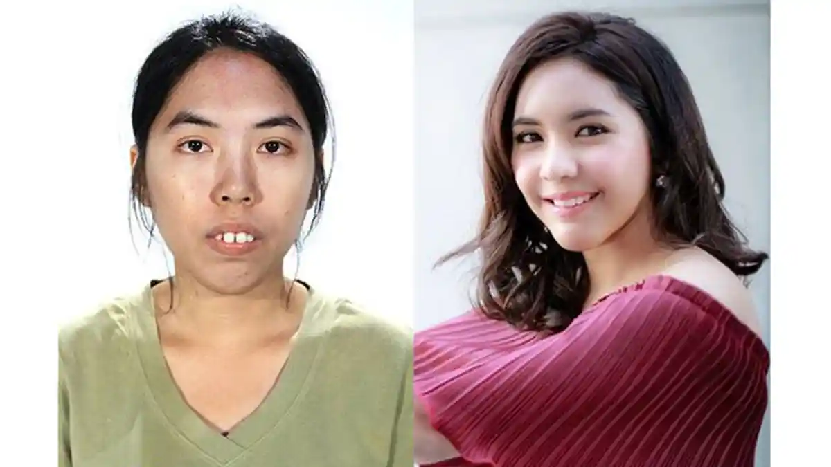 Begini Perubahan 5 Artis Ini Sebelum dan Sesudah Operasi Plastik, No 4 Berubah Drastis, Beda Banget!