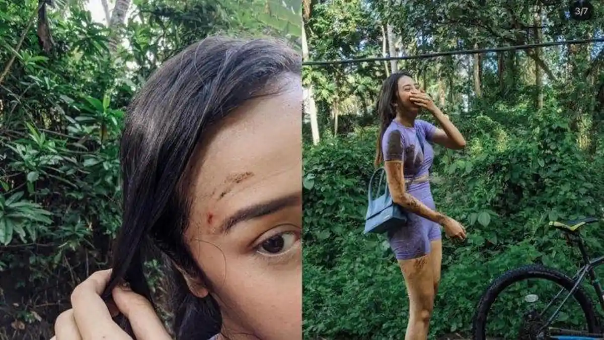 Jatuh dari Sepeda, Anya Geraldine Terluka, Pelipis Mata Kanan Sobek & Berdarah