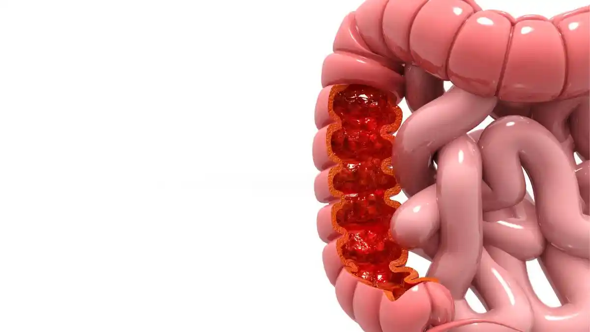 Berjalan Kaki Dapat Mencegah Penyakit Kanker Usus Kanker Payudara & Diabetes, Ini Penjelasannya !