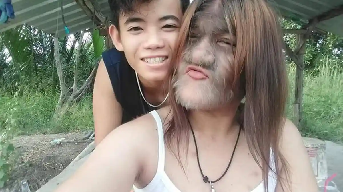 Sosok Wanita Berwajah Penuh Bulu, Ternyata Cantik dan Sudah Punya Pacar