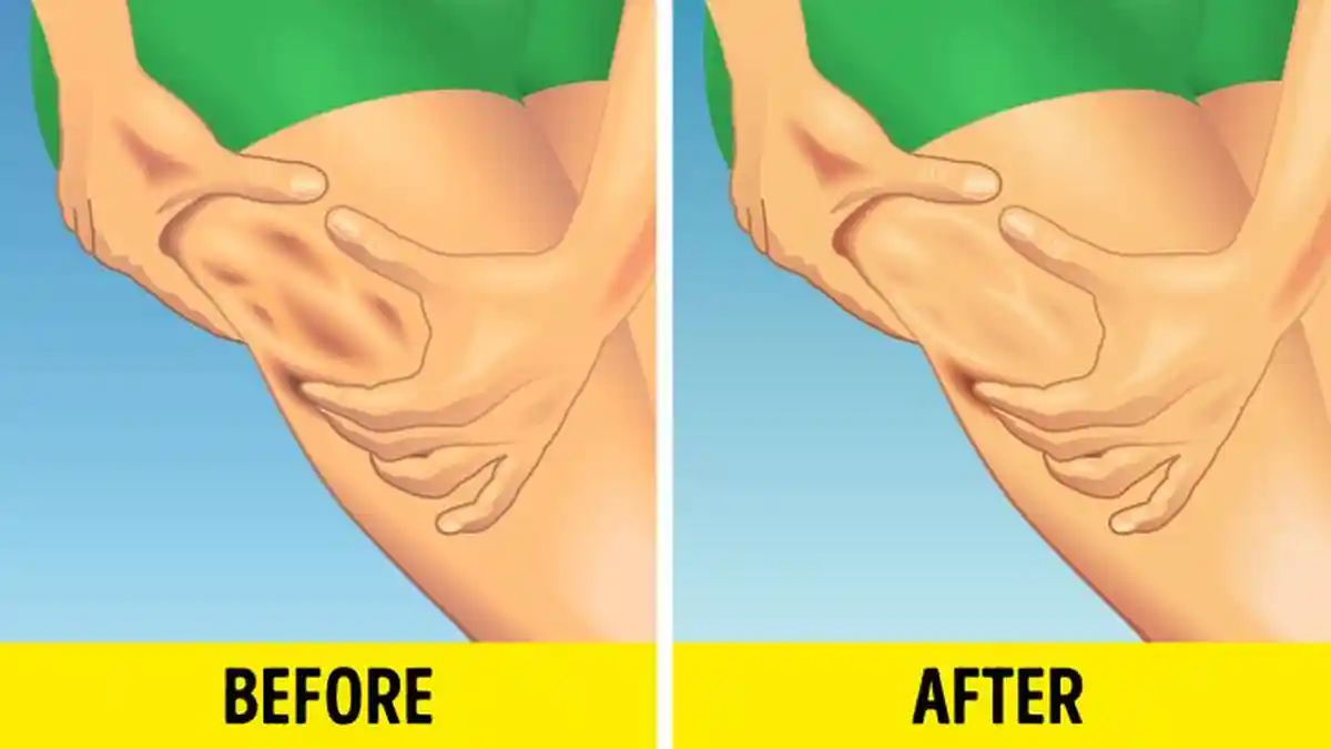 5 Tips Mengurangi Selulit dari Ahli Dermatologi, Pemijatan Hingga Penyikatan