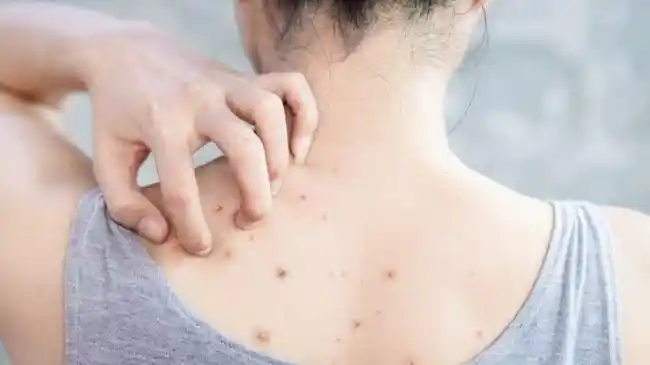 Jerawat di Punggung Jangan Dianggap Sepele, Ini  Penjelasan Dokter