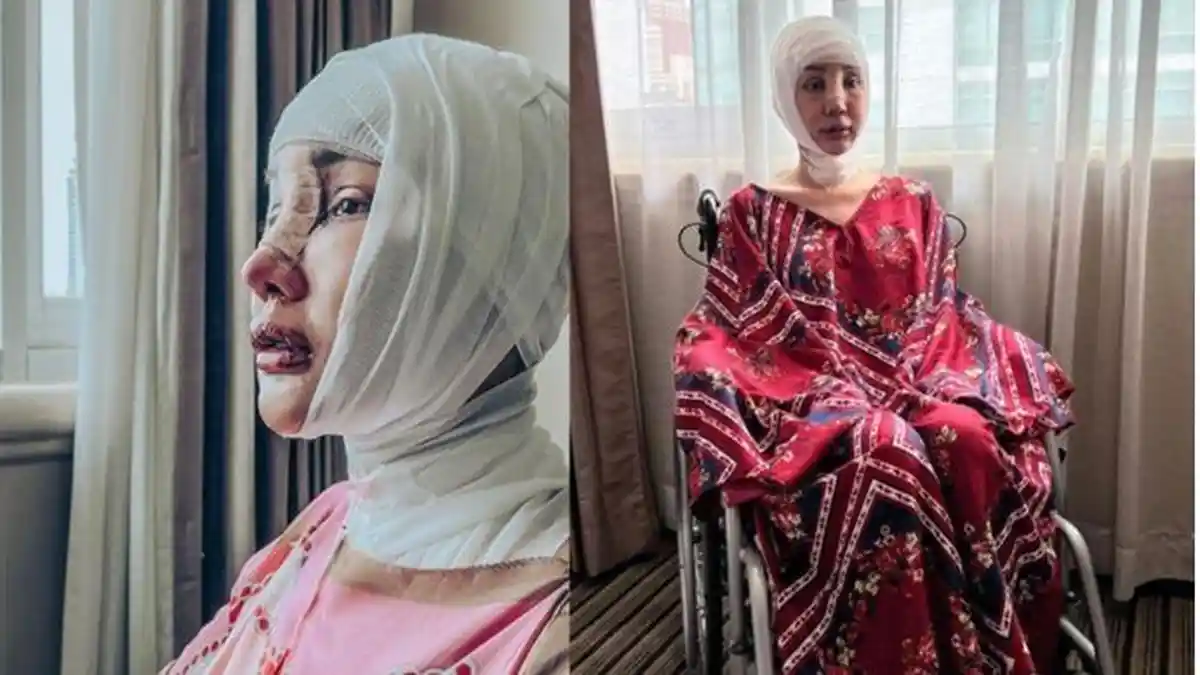 Ngeri Leher Lucinta Luna Sobek Pasca Operasi, Jahitannya Belum Kering Tapi Sudah Terlalu Aktif