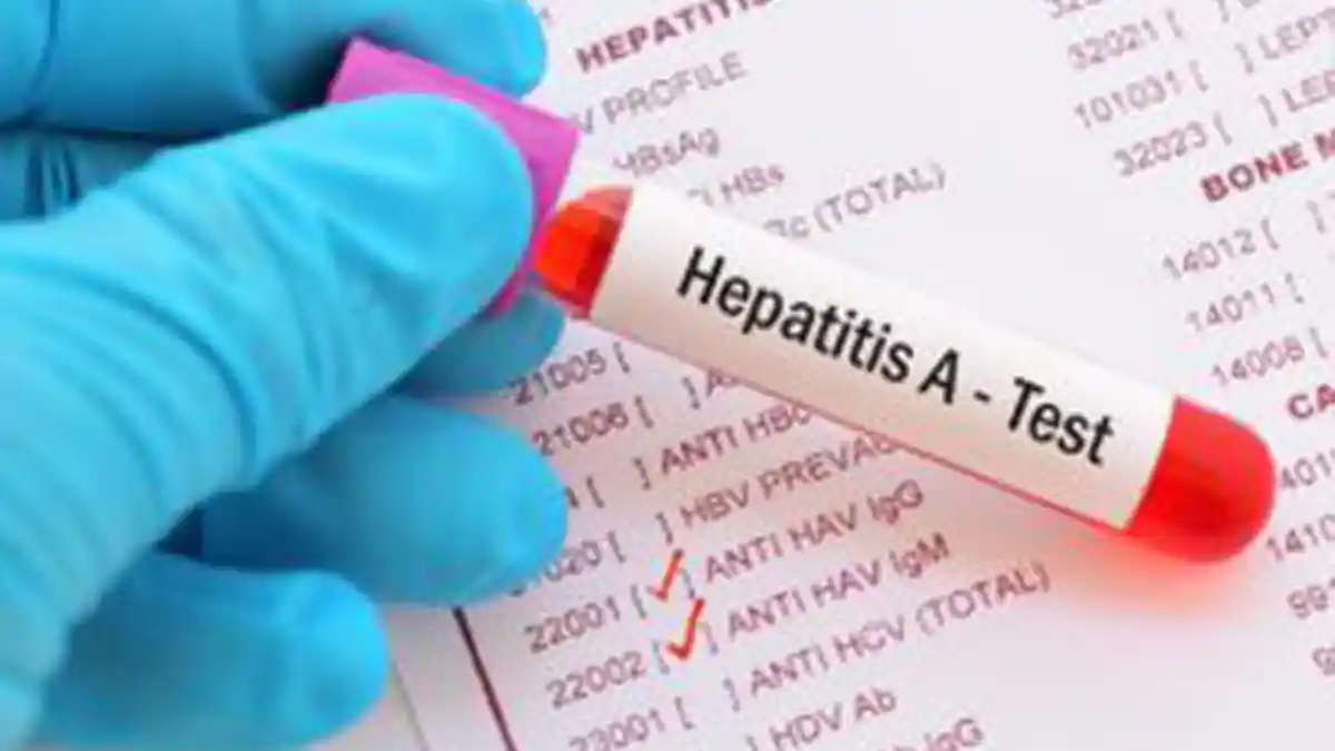 Cara Penanganan Penderita Hepatitis A, Anda Harus Istirahat Total Selama Terjangkit Hepatitis A