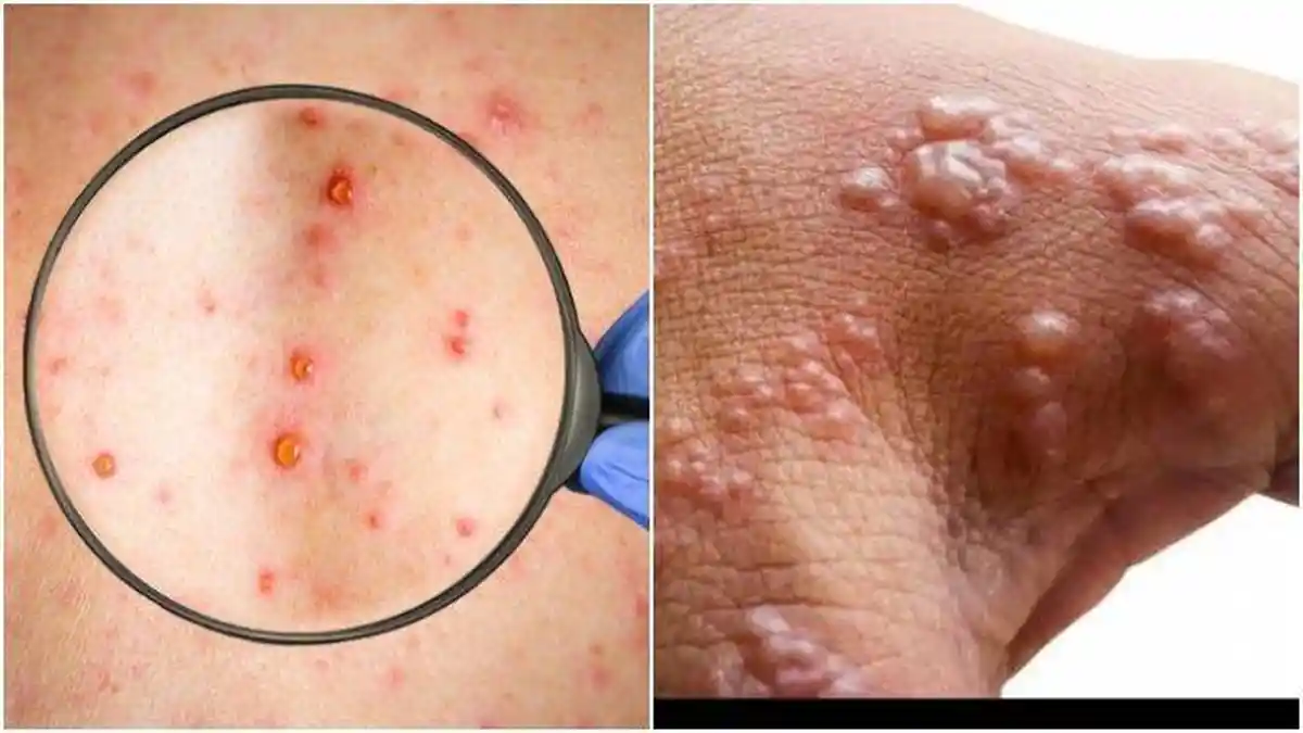 Perbedaan Monkeypox dengan Cacar Biasa, Dokter Jelaskan Gejala Cacar Monyet