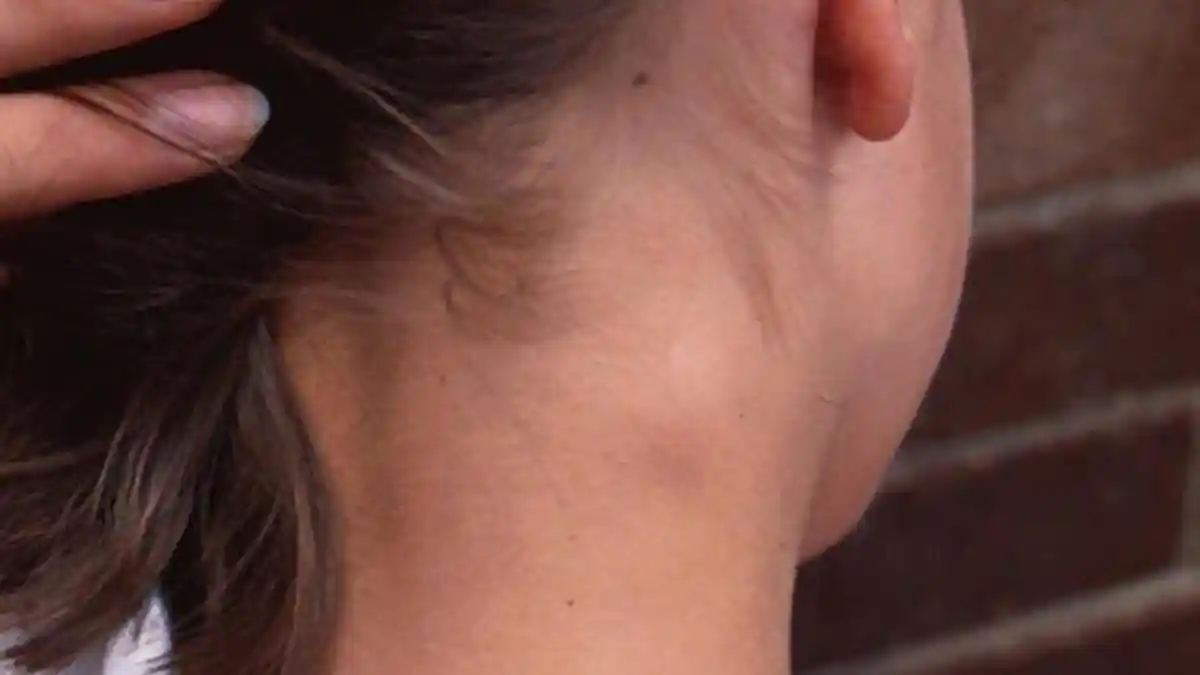 Mengenal Limpo dan Limfoma, Beda Tumor Jinak dan Kanker Kelenjar Getah Bening yang Berbahaya