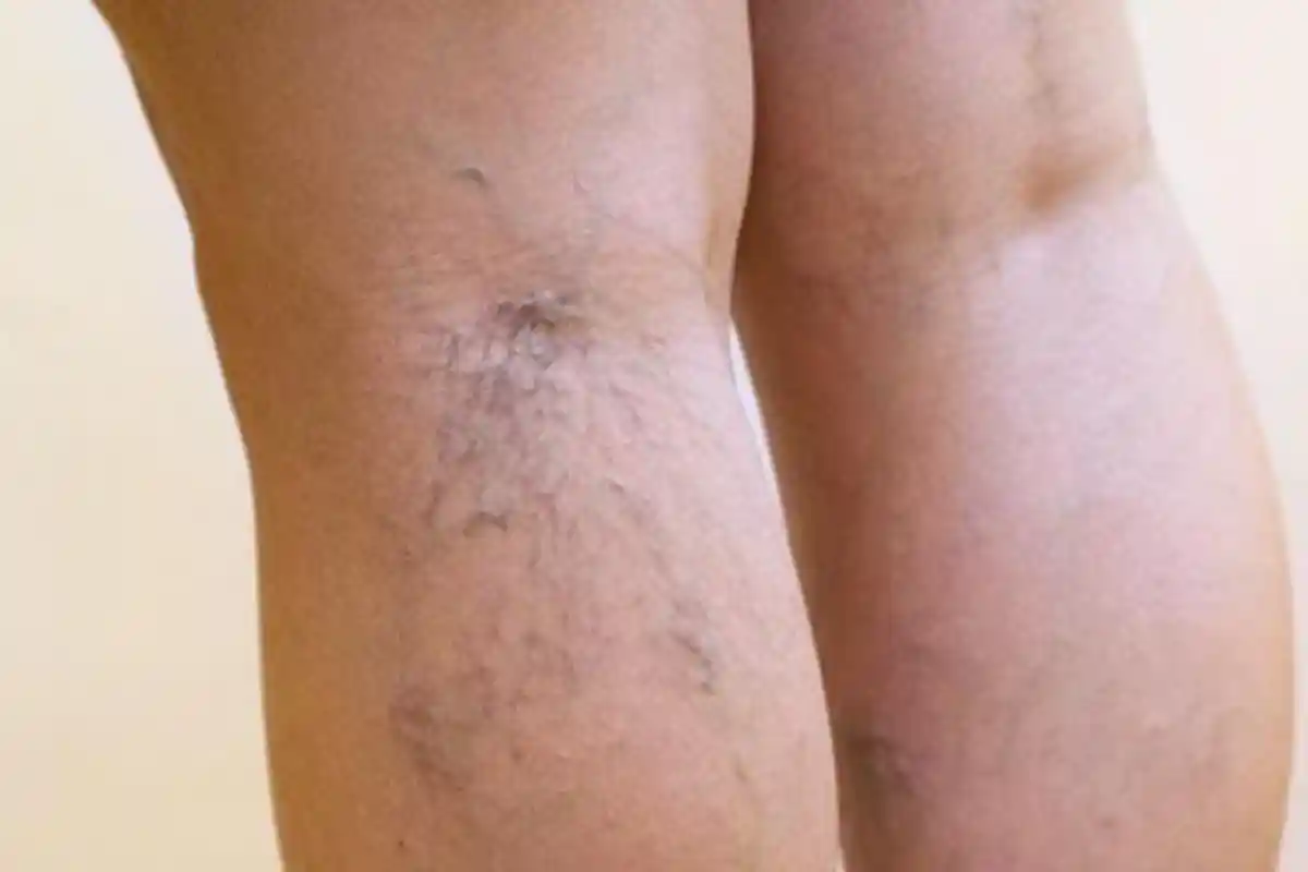 Cara Menghilangkan Varises di Kaki - Oles Pijat dengan Cuka Apel, Pakai Bawang Putih, Cabai Rawit