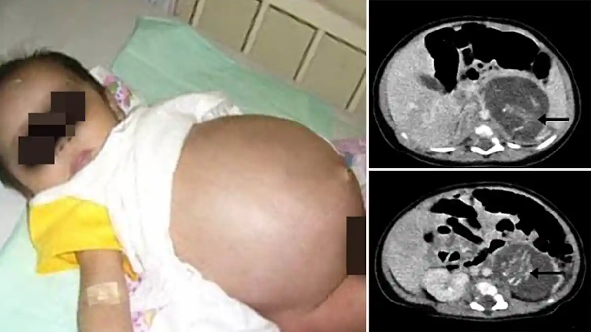 Bayi Ini Lahir dengan Kondisi Perut Bengkak, Dokter Terkejut Temukan Dua Makhluk Ini di Rahimnya