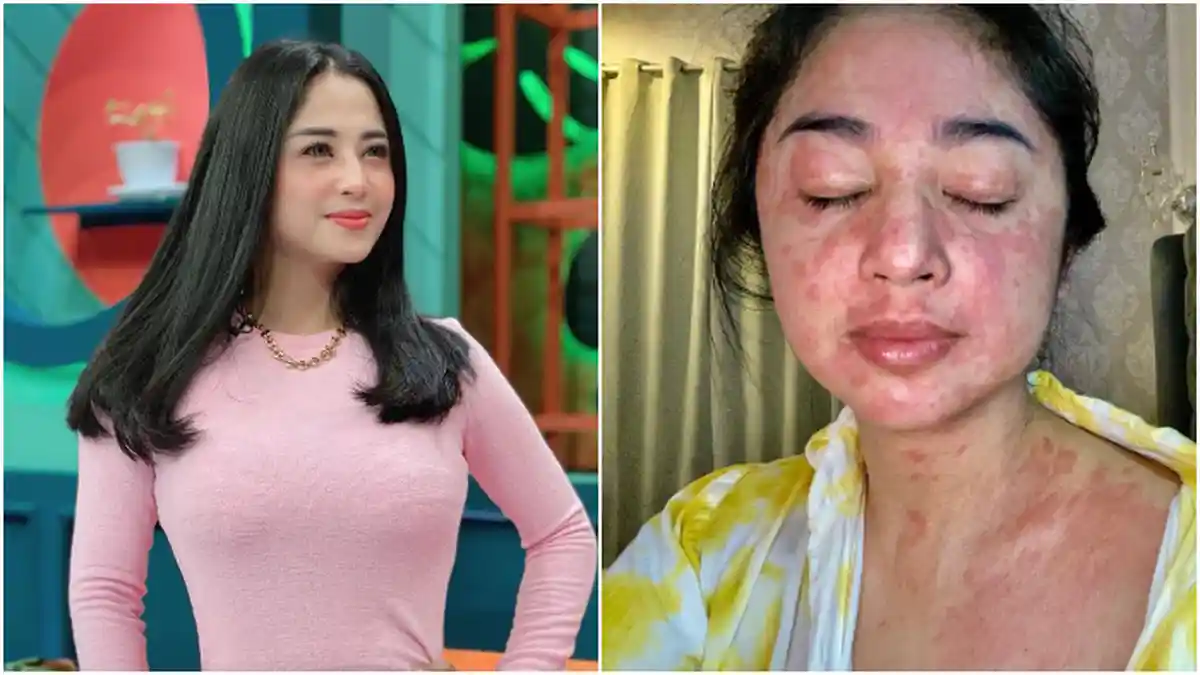 Dewi Perssik Kabarkan Dirinya Positif Covid-19 dengan Gejala Langka, Wajah Bentol Kemerahan