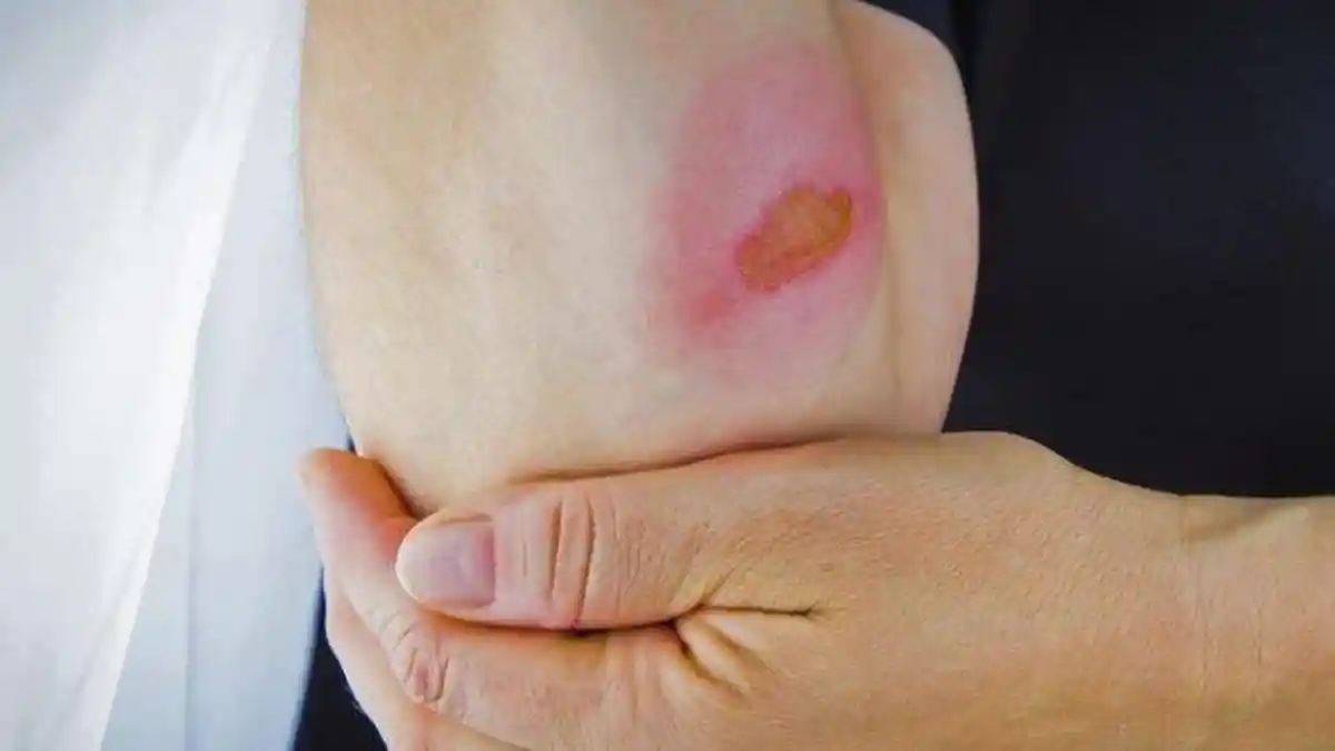 8 Cara Menghilangkan Bekas Luka di Tubuh yang Sering Menggangu Penampilan
