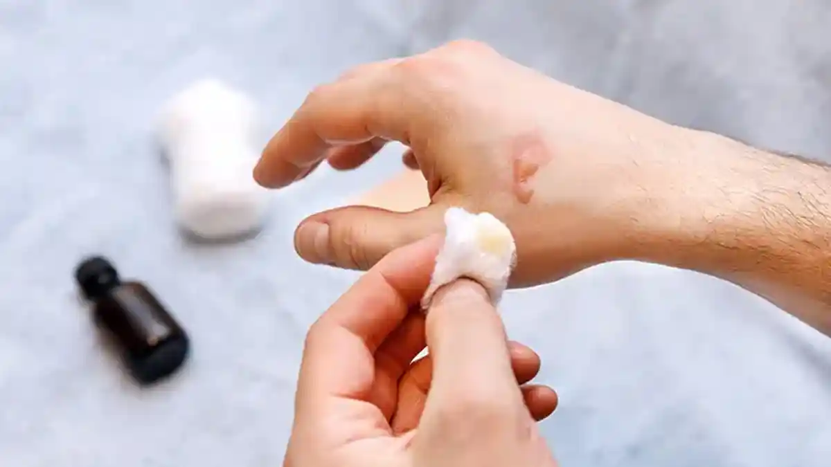 Kecipratan Minyak Panas? Ini 5 Cara Mengatasi Luka Bakar dengan Mudah, Jangan Pakai Odol