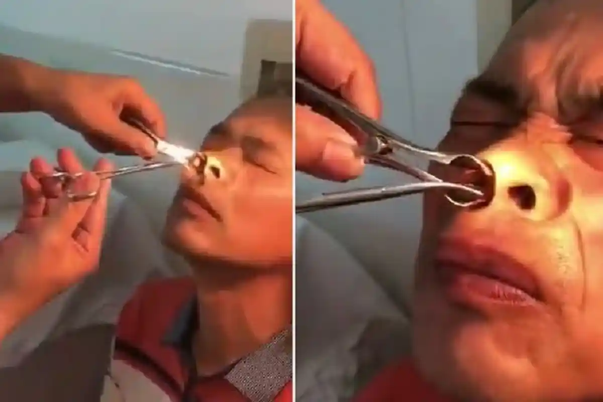 Merinding! Mimisan Berhari-hari, Setelah Diperiksa Ada Lintah di Hidung Pria Ini