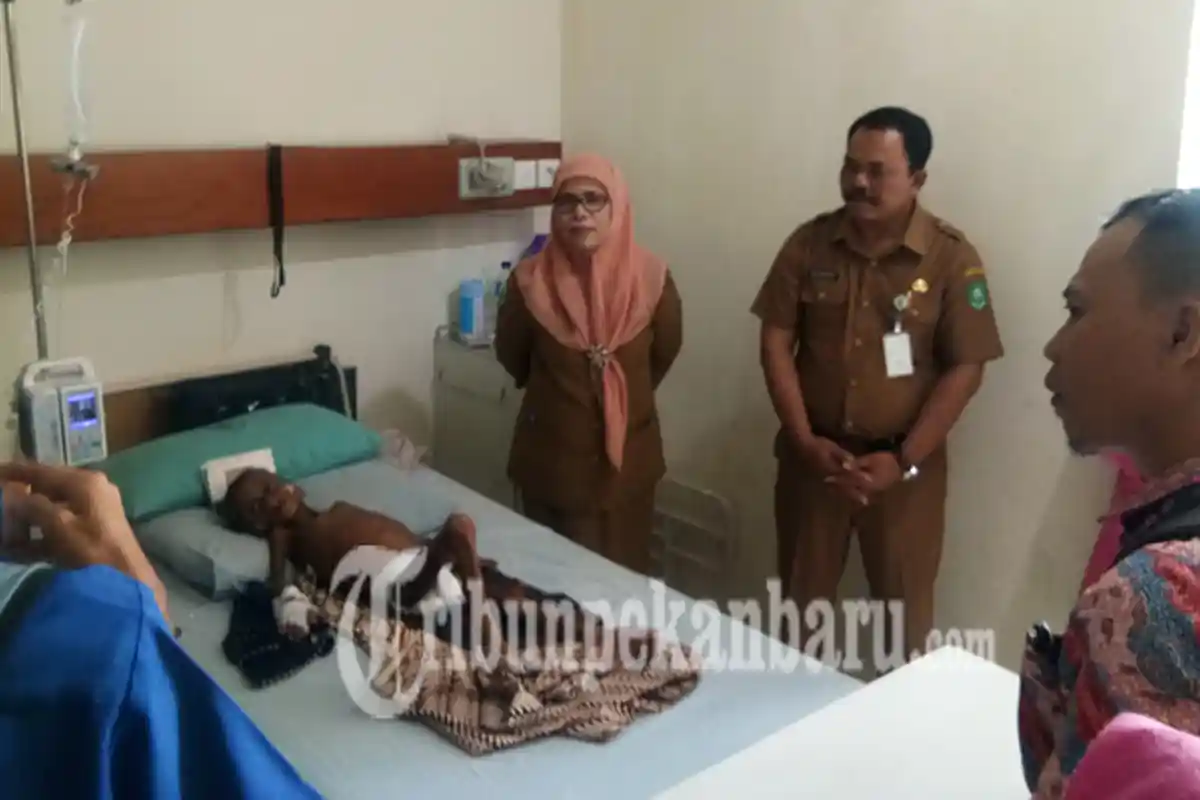 RSUD Bengkalis Pastikan Pelayanan Terbaik untuk Perawatan Irwan Anak Penderita Kelainan Jantung