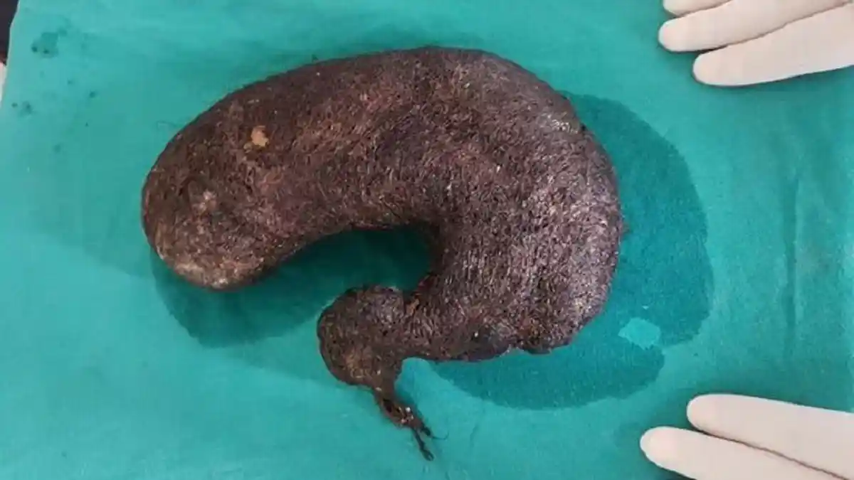 Sering Muntah, Dokter Temukan Benda Mengerikan Seberat 2 Kilo di Perut Gadis Remaja Ini