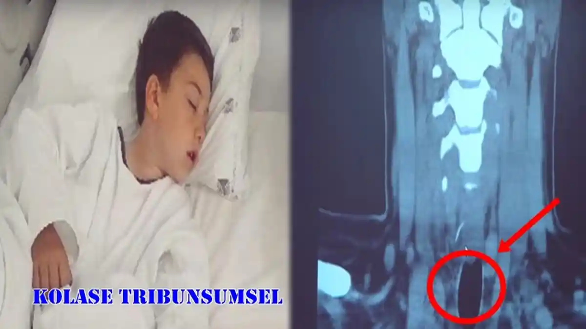 Usai Santap Barbekyu,Bocah Kritis Dirumah Sakit,Hasil X-ray Bikin Dokter Lakukan Operasi,Ternyata!