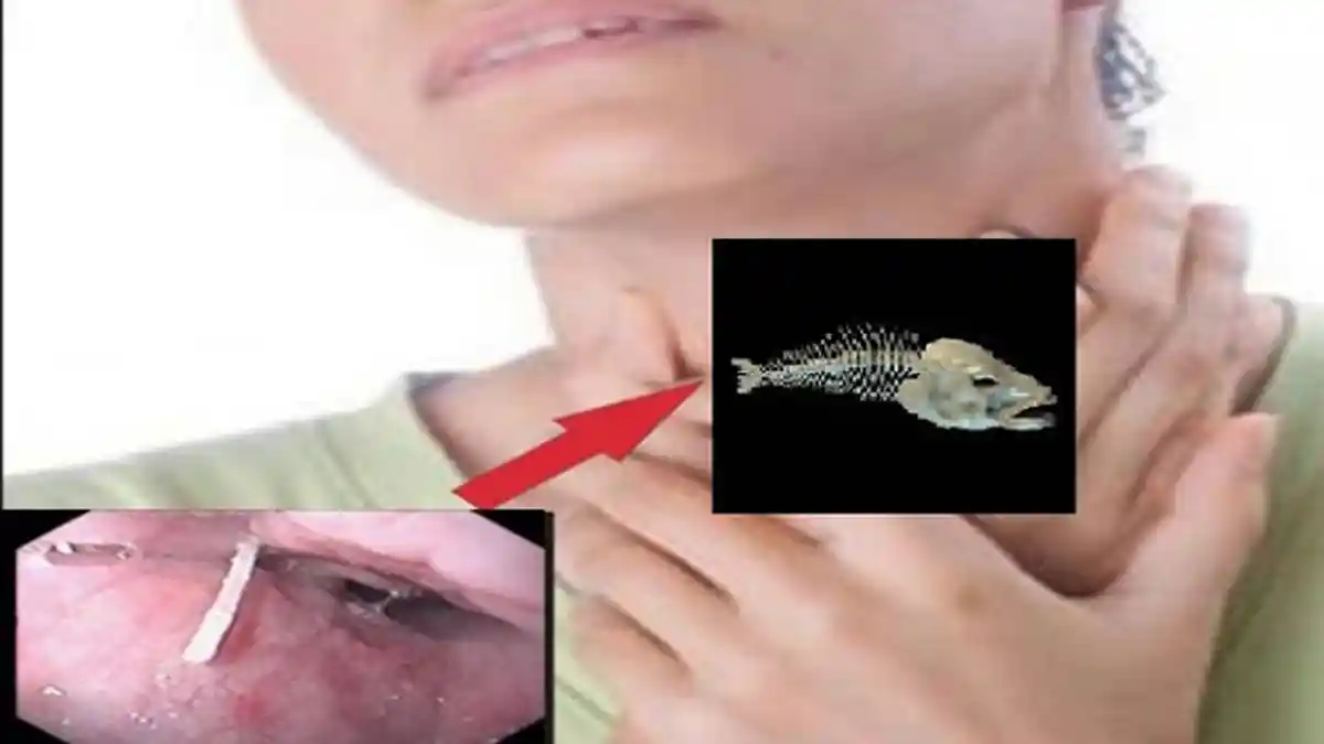 Saat Duri Ikan Tersangkut di Tenggorokan, Lakukan 8 Cara Ini Untuk Mengatasinya