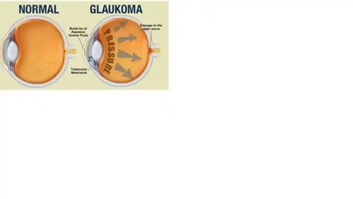 Mengenal Glaukoma: Si Pencuri Penglihatan
