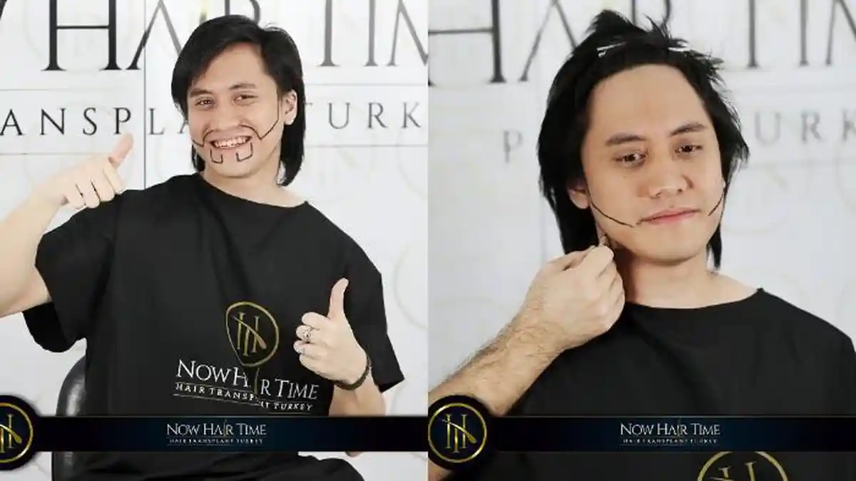Akui Kurang Percaya Diri, Kevin Aprilio Lakukan Transplantasi Rambut di Turki