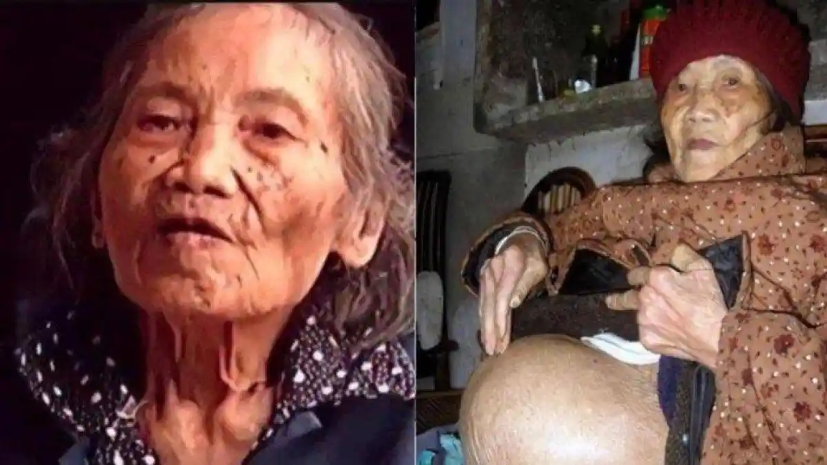 Tak Punya Biaya ke Rumah Sakit, 60 Tahun Janin Dibiarkan Mati di Dalam Perut, Operasi Nenek Ditolak