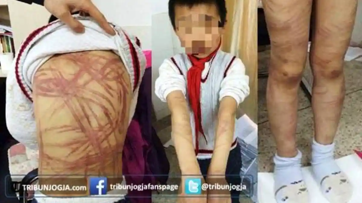Bocah Disiksa Hanya Gara-Gara Tak Tahu Kisah Pinokio