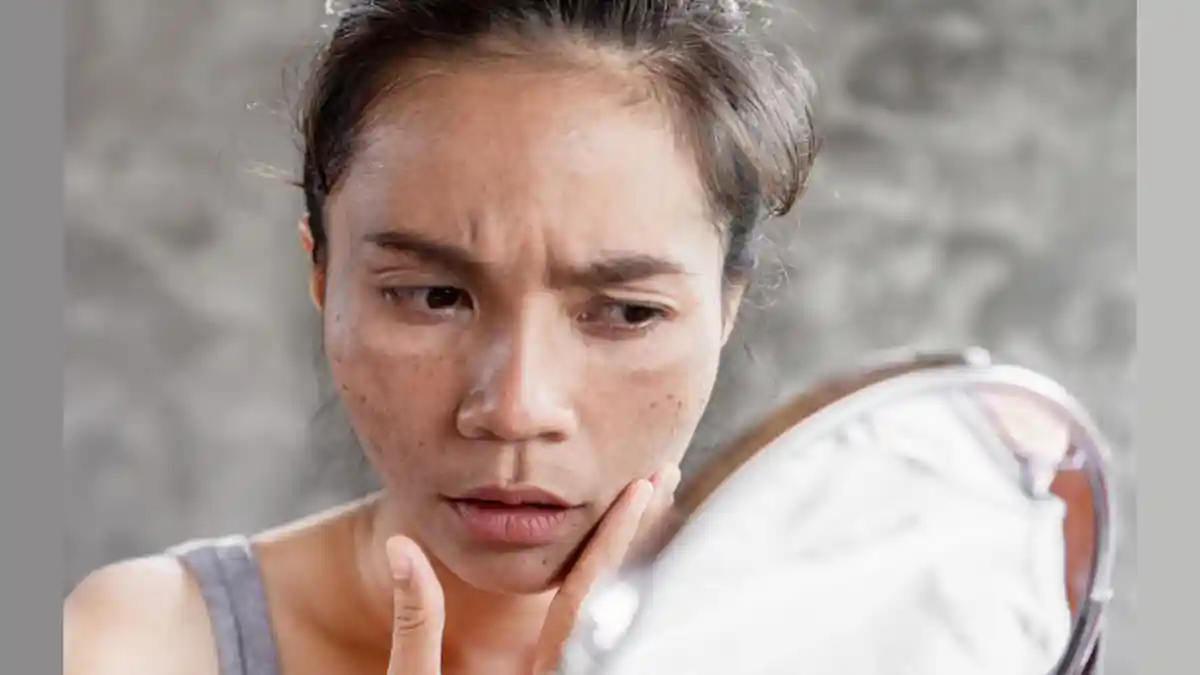 Panen Jerawat meski di Rumah Saja? Cari Tahu Penyebab dan Cara Mengatasinya: Jangan Malas Cuci Muka