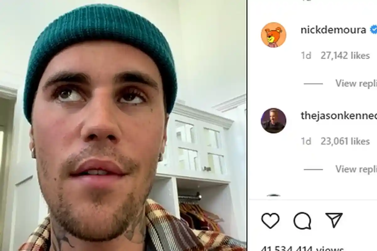 Kenali Penyebab Ramsay Hunt Syndrome yang Kini Dialami Justin Bieber, Penanganannya Tak Sembarang