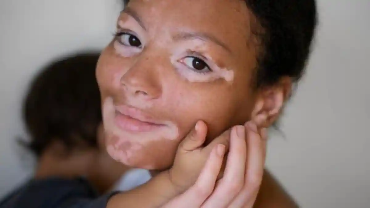 Mengenal Penyakit Vitiligo, Kondisi Kulit dengan Bercak Putih Pucat di Area Tertentu