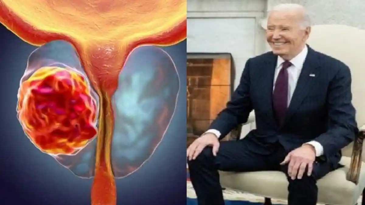 Joe Biden Eks Presiden AS Kena Kanker Prostat Agresif, Apa Itu? Ini Gejala dan Ancaman Pria Lansia