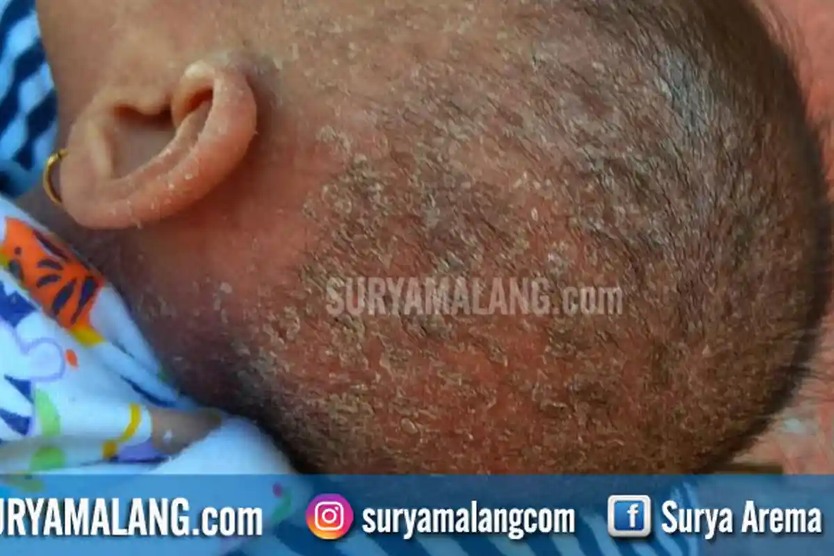 Aneh! Banyak Orang di Beberapa Desa Mendadak Kulitnya Bersisik dan Gatal