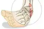 Nyeri Saat Menggerakan Pergelangan Kaki, Bisa Jadi Tanda Cedera Ankle